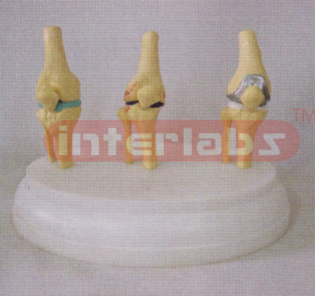 MIDDLE ADULT DISEASE KNEE JOINT